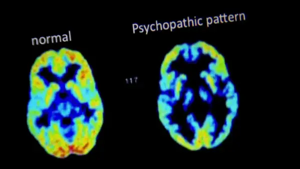 Confronto tra scansioni cerebrali: "normal" mostra attività diffusa, "psychopathic pattern" evidenzia aree con minore attività, utili per capire come riconoscere uno psicopatico.